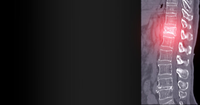 Lumbar Spine CT Imaging with L1 Compression Fracture.A vivid CT scan image highlighting a compression fracture at the L1 level of the lumbar spine.