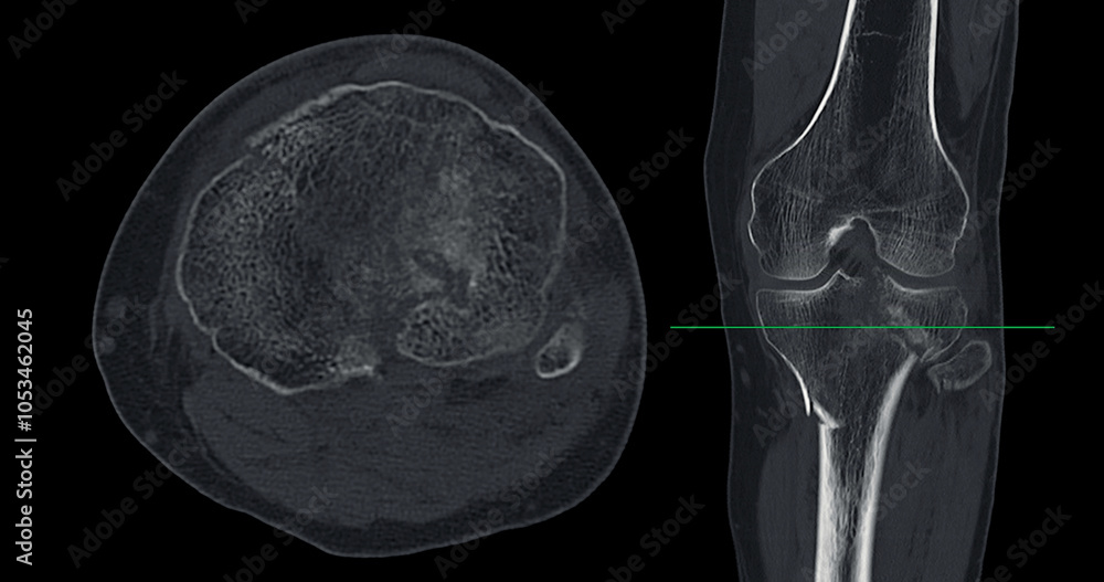 Poster ct imaging of tibia and fibula fracture in trauma case .a detailed ct scan highlighting a traumatic 