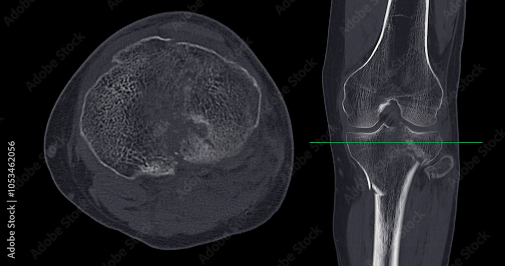 Poster ct imaging of tibia and fibula fracture in trauma case .a detailed ct scan highlighting a traumatic 