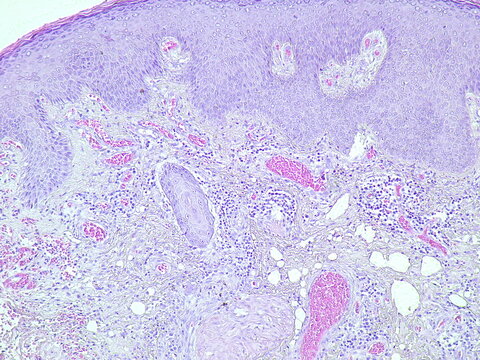 Suppurative inflammation, microscopic view of tumor regio inguinal show cellular material, polymorphs, lymphocytes and histiocytes. pathology laboratory