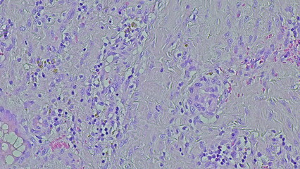 image under the microscope of non-specific chronic inflammation in septic arthritis in the...