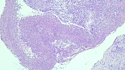 Photomicrograph of pyogenic granuloma, in rectal tumor under microscope in anatomical pathology...