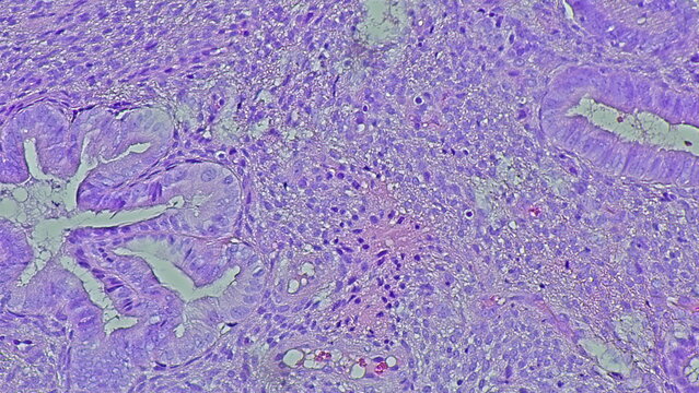Photomicrograph of an endocervical polyp under a microscope in an anatomical pathology laboratory