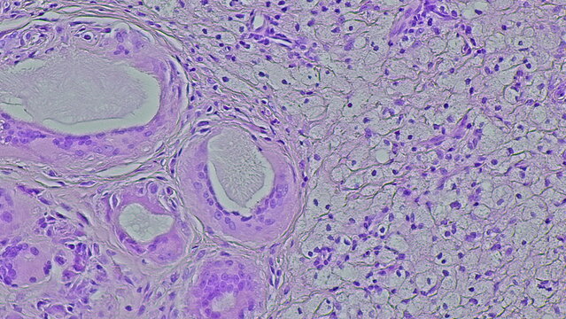 Photomicrograph of a soft tissue tumor in the dextra manus area in the anatomical pathology laboratory