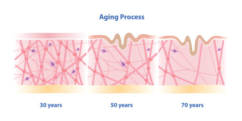 Cross section of aging process skin comparison vector illustration isolated on white background. High density, depletion and low density of collagen, elastin fibers and fibroblasts in the dermis.