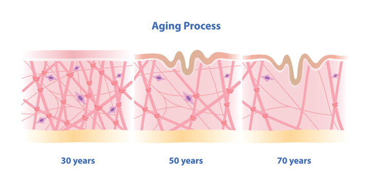 Cross section of aging process skin comparison vector illustration isolated on white background. High density, depletion and low density of collagen, elastin fibers and fibroblasts in the dermis.