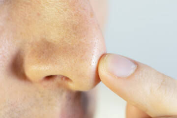 Blackheads on mans nose. Acne problem, comedones. Close up.