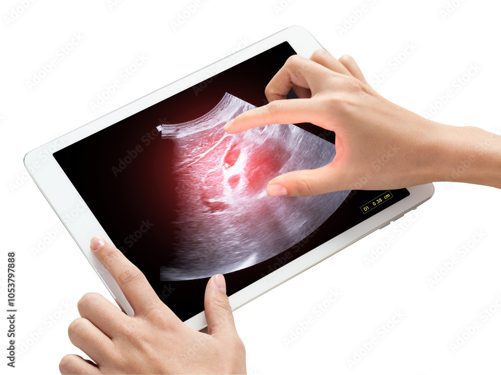 Poster a hand zooms in on an ultrasound scan displayed on a tablet revealing several small gallbladder poly