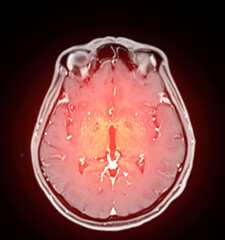 MRI scan of the brain with highlighted regions in red, potentially indicating areas of concern. Ideal for use in neurological diagnostics, medical research, and educational content.
