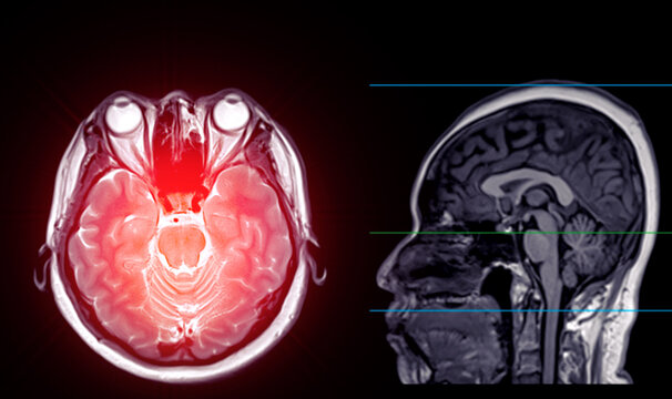 A normal contrast-enhanced MRI scan of the brain showing clear ventricles and surrounding brain tissue, with no abnormalities detected, indicating normal neurological health.