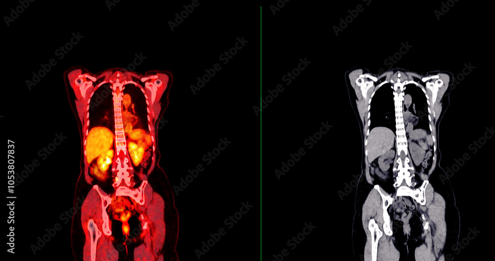 Poster pet scan image displaying whole-body metabolic activity in a side profile view. suitable for medical
