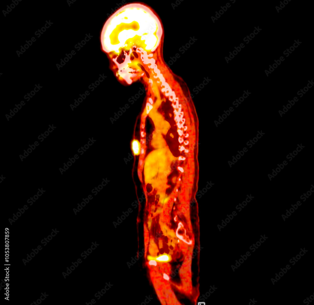 Poster pet scan image displaying whole-body metabolic activity in a side profile view. suitable for medical