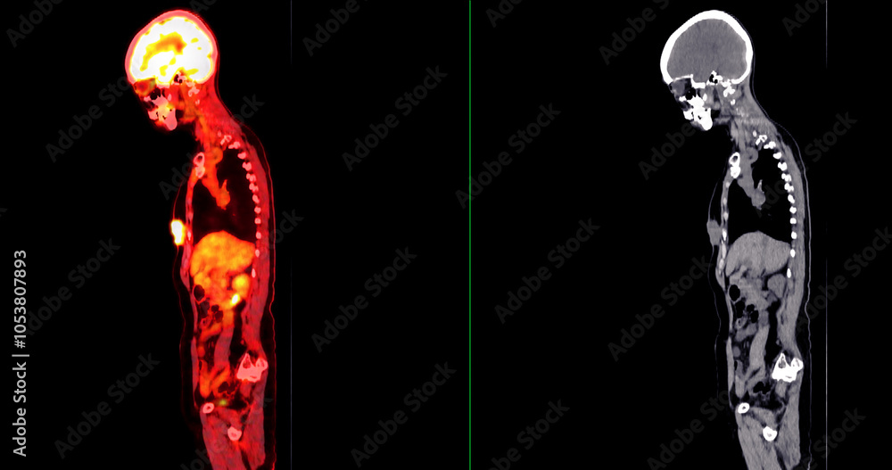 Poster pet scan image displaying whole-body metabolic activity in a side profile view. suitable for medical