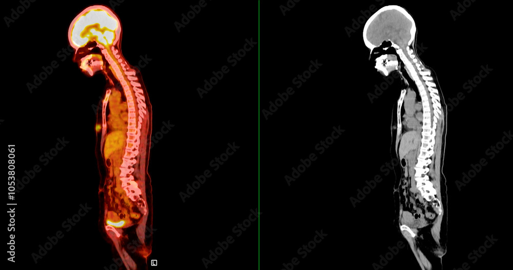 Poster pet scan image displaying whole-body metabolic activity in a side profile view. suitable for medical