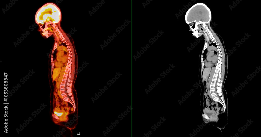 Poster pet scan image displaying whole-body metabolic activity in a side profile view. suitable for medical