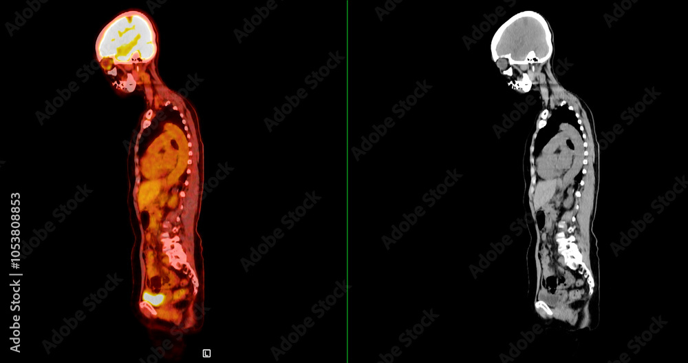 Poster pet scan image displaying whole-body metabolic activity in a side profile view. suitable for medical