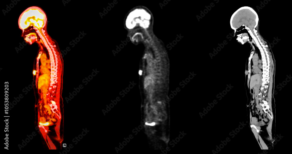 Poster pet scan image displaying whole-body metabolic activity in a side profile view. suitable for medical