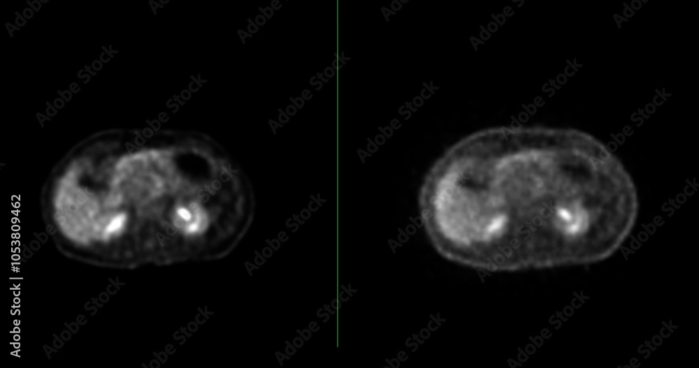 Poster pet scan image displaying whole-body metabolic activity in a side profile view. suitable for medical
