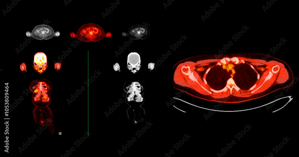 Poster pet scan image displaying whole-body metabolic activity in a side profile view. suitable for medical