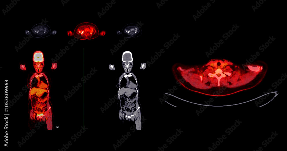 Poster pet scan image displaying whole-body metabolic activity in a side profile view. suitable for medical