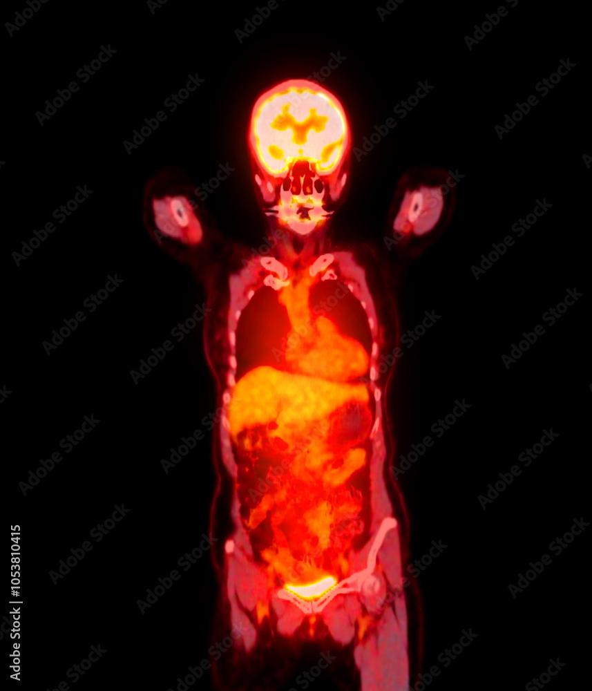 Poster pet scan image displaying whole-body metabolic activity in a side profile view. suitable for medical