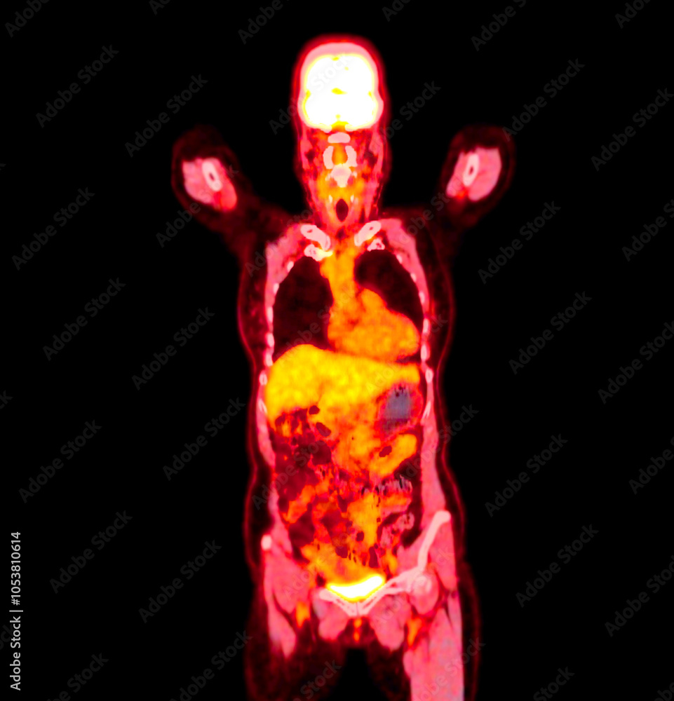 Poster pet scan image displaying whole-body metabolic activity in a side profile view. suitable for medical