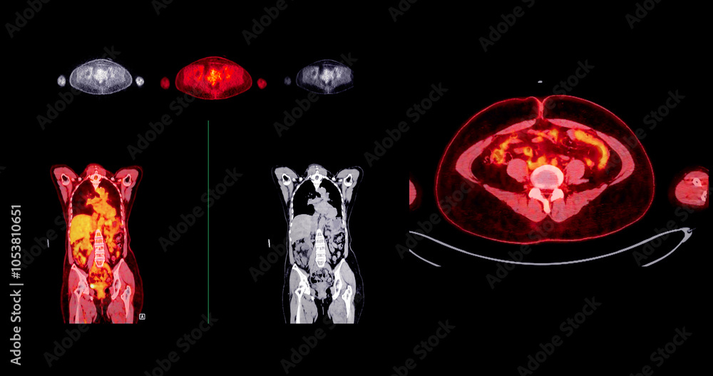 Poster pet scan image displaying whole-body metabolic activity in a side profile view. suitable for medical