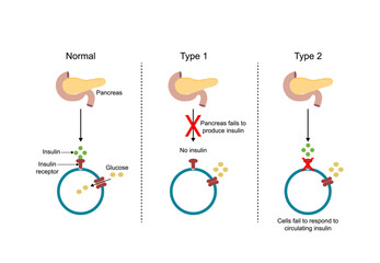 Diabetes mellitus type 1, pancreas's failure to produce enough insulin and type 2, cells fail to respond to insulin (Insulin resistance). Result in high blood glucose levels. Vector illustration