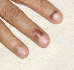 Hot oil splashed on the skin and caused a painful burn. The skin turned red and developed blisters,...