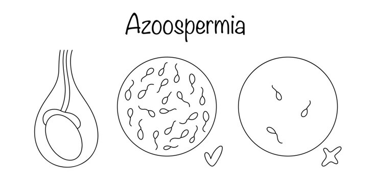 Azoospermia