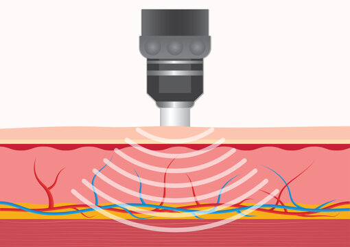 Extracorporeal shockwave therapy (ESWT) treats.