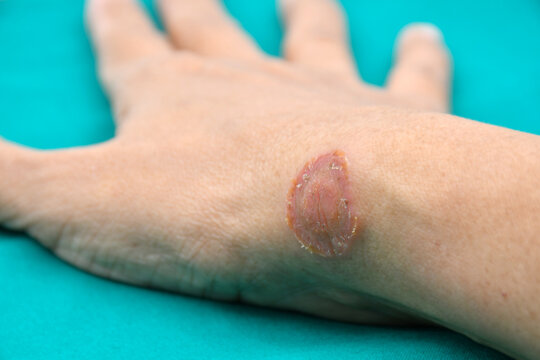 Microsporum canis lesion, a fungus infections on human skin transmitted by contact.