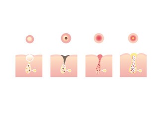 ニキビのイラスト