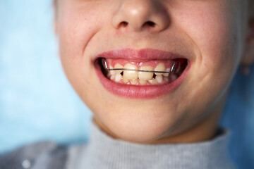Cute girl with teeth retainers looking at camera, close-up. Child with orthodontic plate in her...