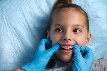 Children's dentistry. A cute girl looking at dentist doctor with teeth retainers, close-up. Child dental check up