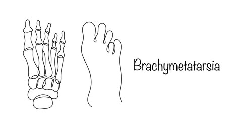 Brachymetatarsia