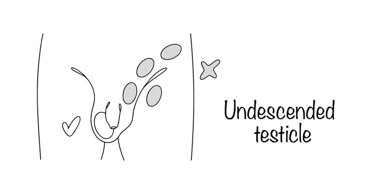 Undescended testicle