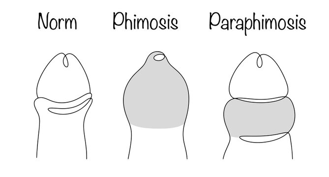 Paraphimosis. Phimosis