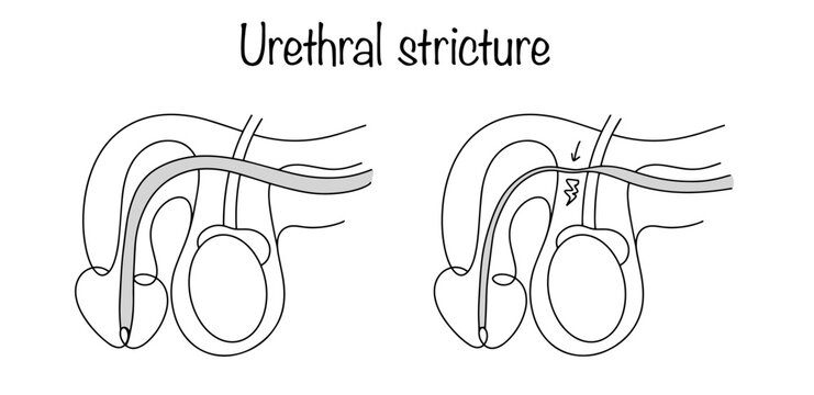 Urethral stricture