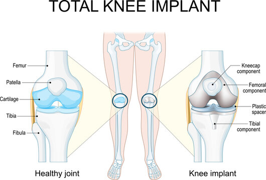Total knee implant