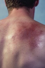 Naklejka premium A person with sunburn on their back, a photograph of the skin discoloration caused by ultraviolet rays from sunlight. generative ai