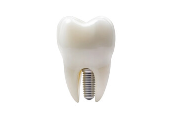 Dental implant model showcasing a realistic tooth structure, ideal for educational and promotional purposes.