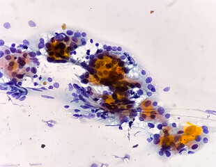 Microscopic image (photomicrograph) of Hashimoto's thyroiditis, an autoimmune disorder of the thyroid that can lead to hypothyroidism