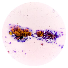 Microscopic image (photomicrograph) of Hashimoto's thyroiditis, an autoimmune disorder of the...