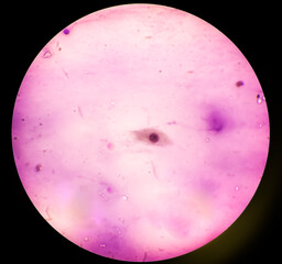 Soft tissue FNAC showing Ganglion under microscopic examination.