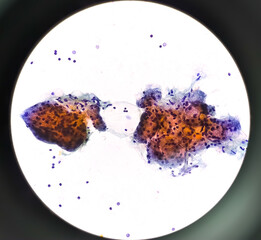 Microscopic image of FNAC of salivary gland showing Sialadenitis.