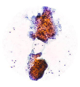 Microscopic image of FNAC of salivary gland showing Sialadenitis.