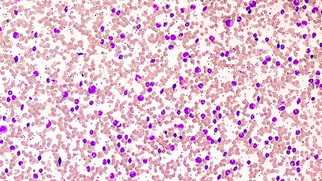 Chronic myelogenous leukemia (CML), also known as chronic myeloid leukemia, is a cancer of the white blood cells. chronic granulocytic leukemia 