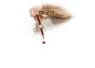 Laboratory blood test. The doctor tests the patient's blood, drips blood onto a glass slide for microscopic analysis.