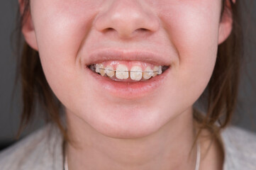 Obraz premium Close-up of a smiling teen girl with braces on her teeth